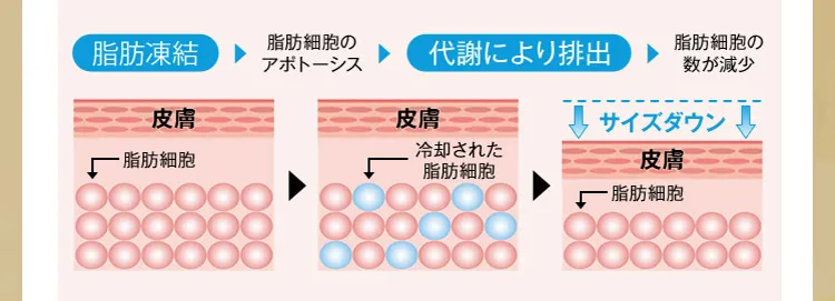 脂肪冷凍　脂肪細胞のアポトーシス　代謝により排出　脂肪細胞の数が減少