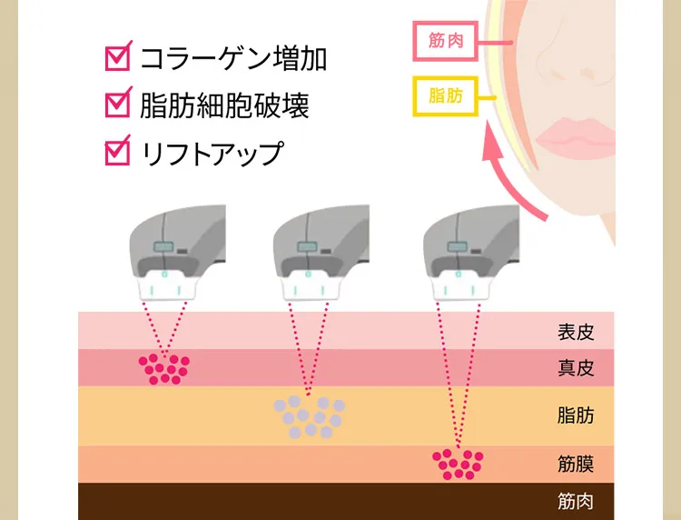 コラーゲン増加　脂肪細胞破壊　リフトアップ