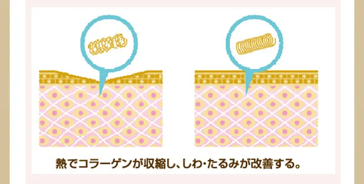 熱でコラーゲンが収縮し、しわ・たるみが改善する。