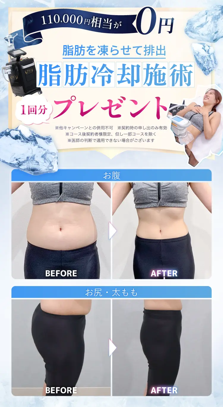 脂肪冷却プレゼント