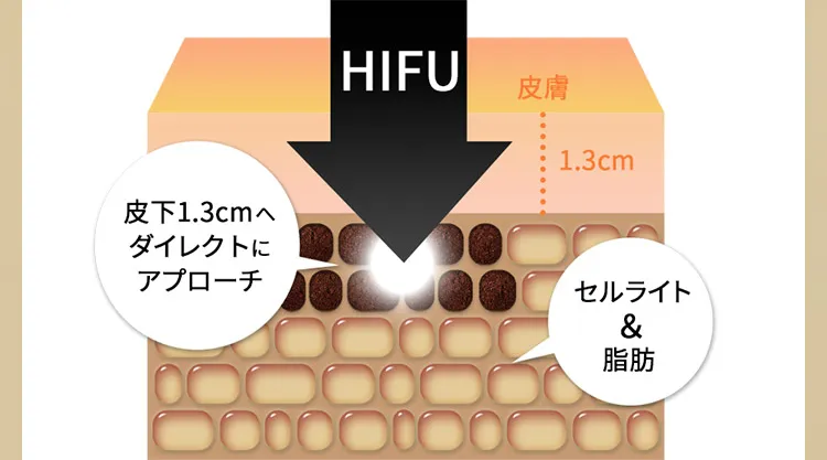 HIFU 皮下1.3cmへダイレクトにアプローチ　セルライト&脂肪