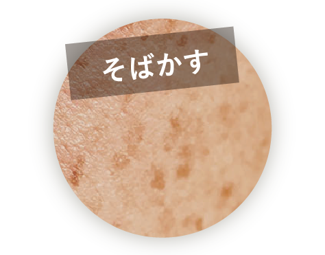 そばかす