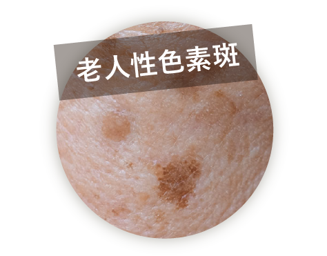 老人性色素斑