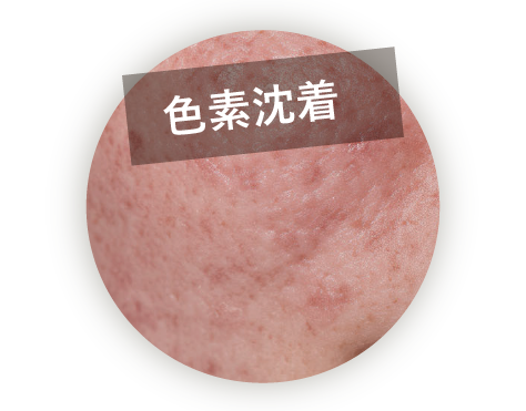色素沈着