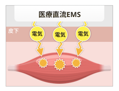 医療直流EMS